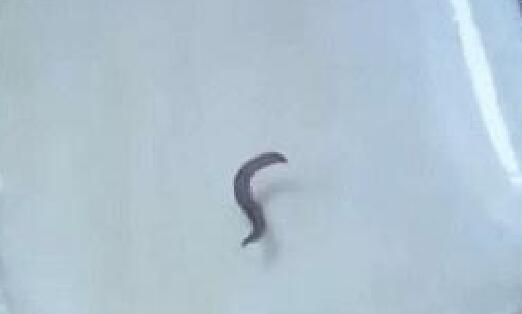 姐弟倆尿液中有黑色活蟲