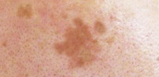 25歲女生長(zhǎng)期熬夜長(zhǎng)出老年斑